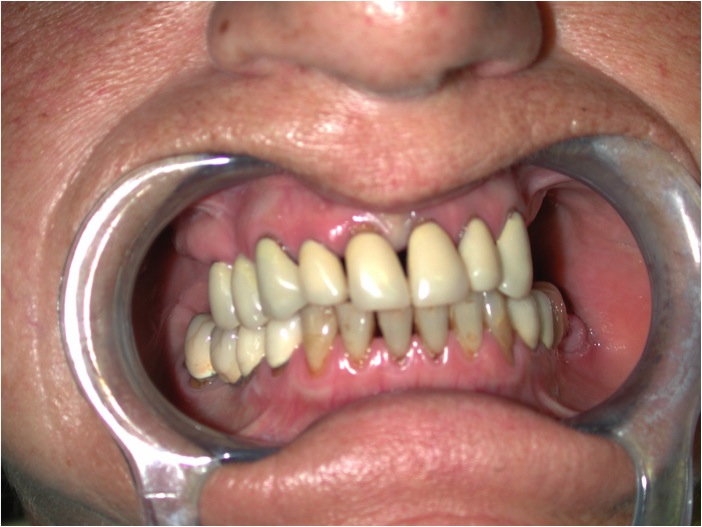 Caso protesico parodontale Foto 2