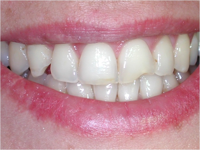 Trauma dentale Foto 2