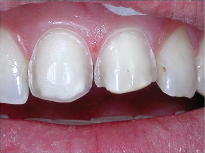 Trauma dentale Foto 4