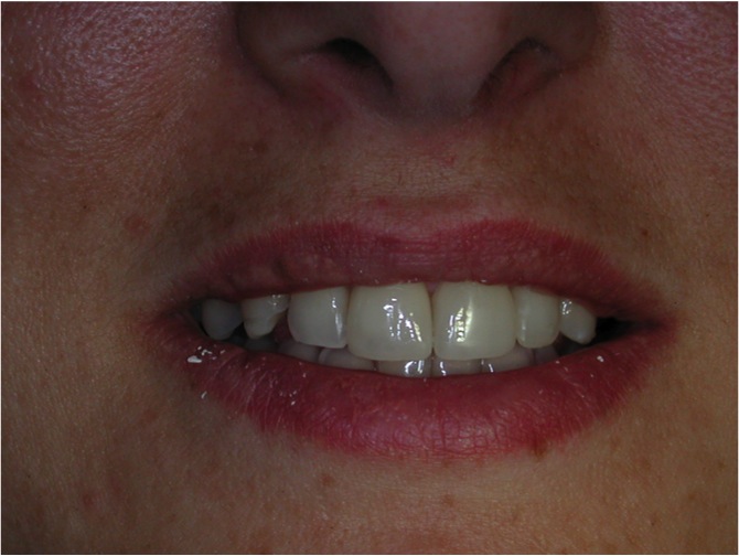 Trauma dentale Foto 5