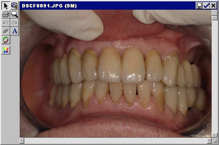 Caso protesico parodontale Foto 6