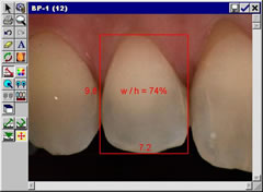 Analisi pc sbiancamento denti