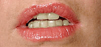 Prima dopo sbiancamento denti